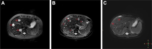 Figure 4 Liver MRI showing multiple metastases.