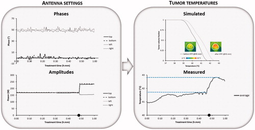 Figure 6. Example showing amplitude steering for patient 3 (cervix) with recorded phases and amplitudes per antenna, the average measured temperature during the steady state period and the simulated temperature distribution in the tumour with the simulated temperature volume histogram before and after correction of the amplitude settings based on treatment planning. Symbol • indicates the time at which amplitude steering was performed to improve tumour temperatures.