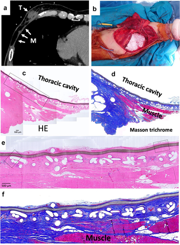 Figure 3. Wide resection of re-recurrent chest wall MPNST (malignant peripheral nerve sheath tumors). (a) Computed tomography of recurrent chest wall MPNST, T indicates tumor; M indicates mesh. (b) Intraoperative picture. (c) Micrograph of hematoxylin–eosin (HE)-stained section; ×40 image. (d) Micrograph of Masson’s trichrome-stained section. Red color indicates muscle tissues. (e) Micrograph of HE-stained section; ×100 image. The brown line indicates ePTFE; the aligned white defects under the ePTFE are the polypropylene mesh. (f) Micrograph of Masson’s trichrome-stained section.