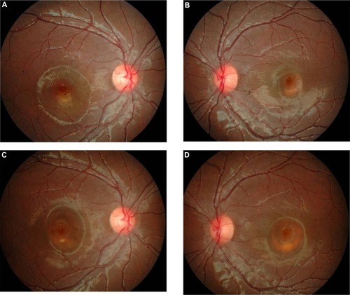 Figure 3 (A–D) Case 3. Color fundus photographs of the fourth child at the time of diagnosis of choroidal neovascularization (A and B). Right fundoscopy at 3 years posttreatment, showing a resolved subfoveal hemorrhage with a residual dome-shaped elevation and yellowish deposits at the foveal region (C). Left fundoscopy at 3 years postpresentation, showing an increase in the size of the dome-shaped elevation, with no sign of a submacular hemorrhage (D).