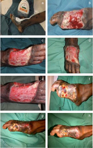 Fig. 2 Photographs of wound healing in Case Study 1. (a) During application of RENASYS-GO. (b,c,d,e) Post-operative day 7, 10, 12, 17 respectively. (f,g,h) Post-SSG week 4, 6, 8 respectively.