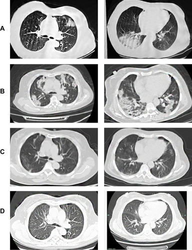 Figure 1 Chest CT images of a 52-year-old woman with COVID-19 pneumonia. Chest CT images (A1 and A2) show patchy ground glass opacities with alveolar consolidation in dependent segments of both lungs with an asymmetric distribution. Three days later, CT images (B1 and B2) revealed a marked increase in lesions. CT images (C1 and C2) on day eight, after five days of corticosteroid use, showed a significant decrease in lesions. CT images (D1 and D2), after six months of follow-up, are normal.