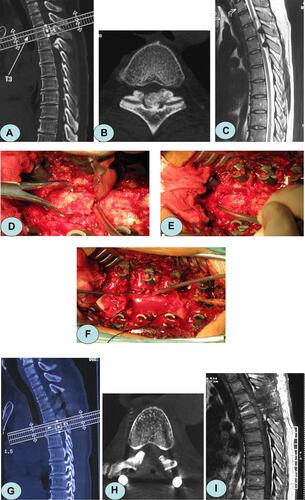 Figure 1 A 56-year-old female patient presented with numbness and weakness in both lower limbs for 19 months. (A, B) Preoperative computed tomography (CT) showed TOLF at the level of T3–5, and ossified ligamentum flavum in fused-type. (C) Magnetic resonance imaging (MRI) showed that the low-signal ossification invaded the spinal canal from the rear, and the spinal cord was severely compressed. (D) The lamina was clamped using a towel clamp, and a bone pry was inserted into the gap at the edge of the free lamina. (E, F) The laminae and ossified ligamentum flavum were excised from the head to the tail. (G, H) Postoperative CT showed that the majority of the vertebral lamina and ossification were removed, and the spinal canal was unobstructed. (I) Postoperative MRI showed disappearance of the compression behind the spinal cord.