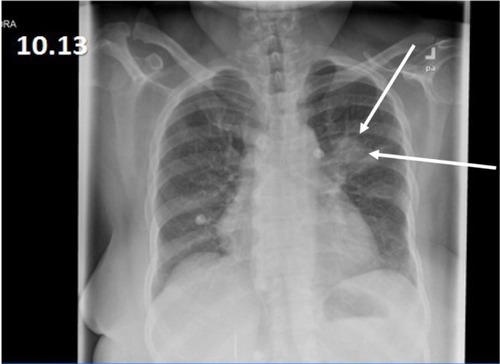 Figure 1 Left upper lobe round infiltrate in chest X-ray.