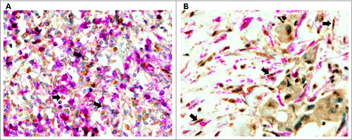 Figure 2. Human mammary carcinomas contain CAFs and MICs expressing metalloproteases and their inhibitors. Representative pictures of double-immunostaining of mammary cancer patient tissue arrays to confirm expression of matrix metalloproteases (MMPs) and tissue inhibitors of metalloproteases (TIMPs) by each type of stromal cell. (A) Positive MMP-11 staining (brown) in mononuclear inflammatory cells (MICs) identified by the CD45 marker (pink) (200X) and (B) Positive TIMP-2 staining (brown) in cancer-associated fibroblasts (CAFs) identified by the α-SMA marker (pink) (200X).