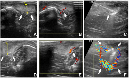 Figure 5. Bilateral knee ultrasound evaluation and monitoring during synovial ablation; A, B: non-RFA side of knee synovial (↑) thickness 6 mm, CDFI synovitis score 1 (↑); C: ultrasound-guided synovial ablation showing RFA pin (↑); D, E: same rabbit RFA side of knee synovial thickness (↑) 7 mm, CDFI synovitis score 1 (↑); F: synovial ablation with CDFI showed annular shape (↑).