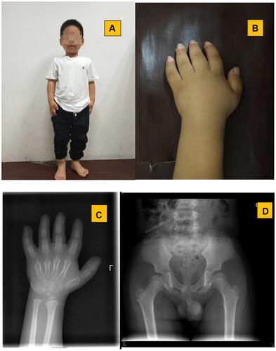 Figure 1 Clinical and radiological features of patient 1: (A) short stature and facial profile; (B) small hand and short fingers; (C) delayed bone age and cone shaped epiphysis; (D) beak-like femoral heads.