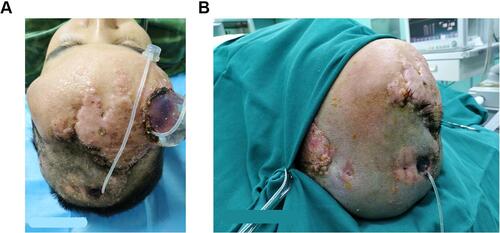 Figure 3 One month after implantation of the dilator. (A) The total amount was 300mL when the water was injected for one month, and the dilator was partially exposed, and the local aseptic bandage was performed. (B) The condition of the skin flap when the expander is removed three months later.