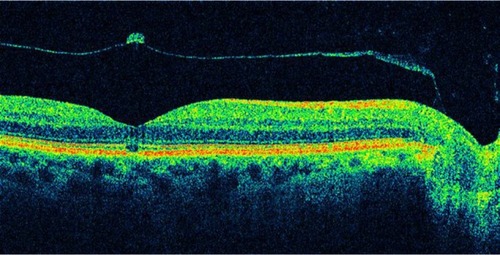 Figure 4 Optical coherence tomography has demonstrated changes in the vitreomacular interface not visible with biomicroscopy.