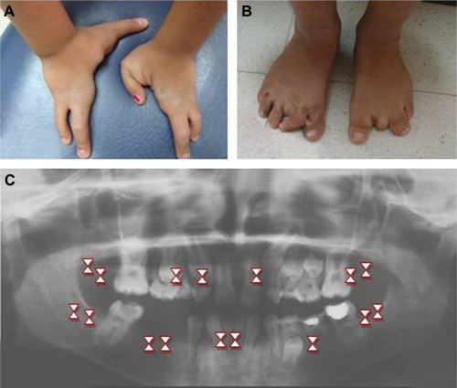 Figure 1 Congenital malformations associated with the reported case.