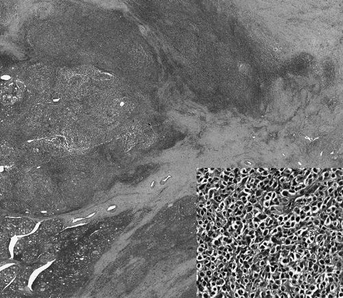 Figure 1.  Tumor in the left thyroid gland showing a picture of a malignant lymphoma with diffuse lymphocyte infiltration and focal lymphoid nodular proliferation on a background of chronic thyroiditis. The nucleus of the tumor cells is small to intermediate sized and irregularly shaped, as shown in the inset (lower right).