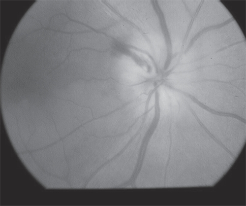 Figure 3 A 57 year old patient with history of hypertension, diabetes and hypercholesterolemia and NAION in his right eye. There is pallid swelling of the right disc with hemorrhage superiorly. The left optic disc has a cup to disc ratio of 0.1 (not shown).