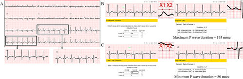 Figure 3 P-wave dispersion (PWD) measurement by WebPlotDigitizer (A) 12-lead electrocardiography with PWD, (B and C) axes calibration and acquired data to measure maximal and minimal P wave duration, respectively. PWD = 115 msec.
