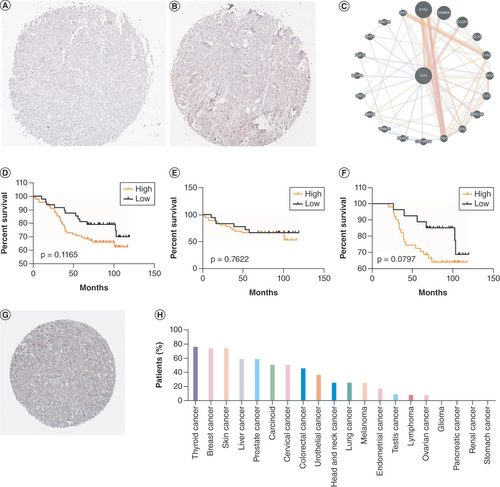 Figure 7. Prognostic value of SIX4 protein level in breast cancer patients. (A & B) Representative staining of SIX4 in breast cancer tissues with (A) low and (B) high expression. (C) Protein–protein interactions of SIX4. (D–F) Overall survival of (D) all breast cancer patients, (E) ER− patients and (F) ER+ patients. (G) Staining of SIX4 in the Human Protein Atlas (HPA031794). (H) The protein expression of SIX4 in different malignancies.ER: Estrogen receptor.