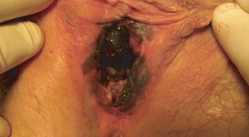 Figure 5. Vulvo-vaginal melanoma seen during clinical examination – case 3.