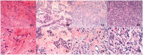 Figure 6. Histopathological images with hematoxylin and eosin staining of uterine fibroids with different signal intensities on T2-weighted MRI. (A) Hypo-intense; (B) Isointense; (C) Heterogeneous intense and (D) Homogeneous hyper-intense. A1–D1: microscopic magnification, × 100; A2–D2: microscopic magnification, × 400.