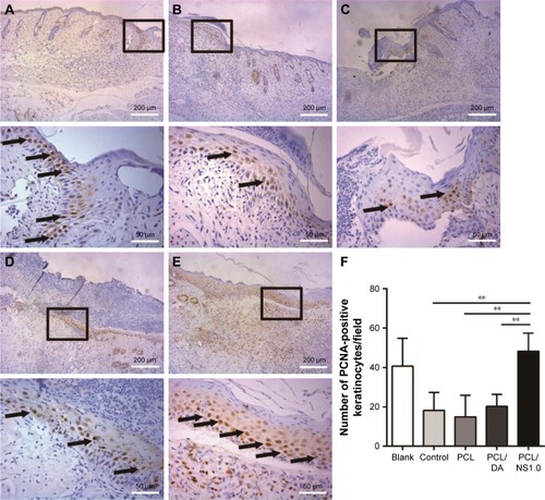 Figure 11 The expression of PCNA in keratinocytes on the edge of wound at day 7 post surgery.Notes: Representative images of immunohistochemical staining of PCNA taken from the (A) blank, (B) control, (C) PCL, (D) PCL/DA and (E) PCL/NS1.0 groups. The rectangular insets represent the magnified areas, while the black arrows indicate PCNA-positive keratinocytes. (F) Counting of PCNA-positive keratinocytes per field in newly generated epidermis. Data are presented as mean ± SD (n=4). Scale bars: 200 µm (low magnification ×100) and 50 µm (high magnification ×400). **p<0.01.Abbreviations: DA, dopamine; NS, nanosilver; PCL, polycaprolactone; PCNA, proliferating cell nuclear antigen.