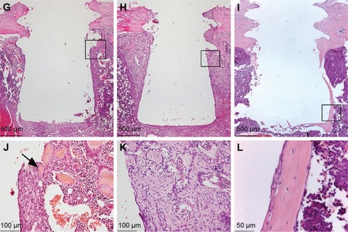 Figure 3 Histological analysis of the tissues around the implants.Notes: The survey light micrographs of paraffin-embedded and H&E stained sections show the morphology of the tissue around Ma (A–F) and Nano (G–I) implants, 3 days (A, D, G, and J), 6 days (B, E, H, and K), and 28 days (C, F, I, and L) after implantation. Implants were gently unscrewed during paraffin embedding in order to reduce artifactual damage to the tissue during separation of implant from tissue. After 3 days, (A, D, G, and J), an organized granulation tissue with localized sites with remaining hematoma is seen. Bone formation in the threads becomes evident in the form of woven bone indicated by arrows. After 6 days, (B, E, H, and K), endosteal downgrowth as well as de novo bone formation can be observed. No inflammatory infiltrates are detected. After 28 days, (C, F, I, and L), the early-formed woven bone is completely remodeled and replaced by mature lamellar bone with flattened osteocytes. The black boxes in (A–C) and (G–I) represent the areas shown in higher magnifications as (D–F) and (J–L), respectively.Abbreviations: H&E, hematoxylin and eosin; Ma, machined; Nano, nanopatterned.