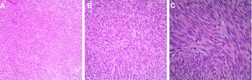 Figure 3 Electron microscope (× 40 [A], × 100 [B], × 200 [C]), hematoxylin and eosin staining of cross-sectioned gastrointestinal stromal tumor; spindle cells and mitotic figures can be seen.