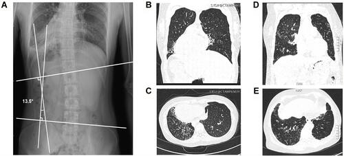 Figure 2 Clinical features of two patients in two consanguineous families. (A) Radiographic image of proband 1 with bronchiectasis showed right left-sided lumbar scoliosis with a Cobb’s angle of 13.5°. (B and C) The chest high-resolution computed tomography (HRCT) scan of proband 1 showed bronchiectasis and the situs inversus. (D and E) The chest HRCT scan of proband 2 showed bronchiectasis.