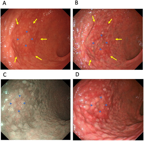 Figure 4. A case of early-stage gastric cancer (well-differentiated adenocarcinoma, 0–IIc, 12 mm, blue arrowhead) located in the greater curvature of the lower body of the stomach with intestinal metaplasia and map-like redness (yellow arrow). A. map-like redness and early-stage gastric cancer using white-light imaging, B. map-like redness and gastric cancer using texture and colour enhancement imaging (TXI) mode 1, C. early-stage gastric cancer using narrow-band imaging and D. early-stage gastric cancer using TXI mode 1.