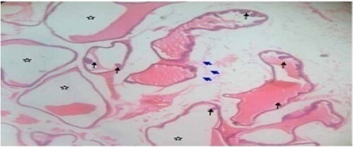 Figure 4. Low dose: Photomicrograph of prostate tissue showed ectasia or dilation of the prostate characterized by acini distended with secretory materials (SM) (star), compression(black arrow) of surrounding unaffected acini with dilation appearing cystic, with fused cuboidal epithelium (blue arrow) lining were present. Infoldings or occasional papillary infoldings was observed. H&E. mag. 400×.