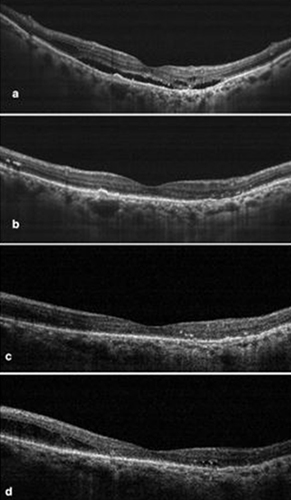 Figure 4 Representative case of nAMD who had previously received 5 anti-vascular endothelial growth factor (anti-VEGF) injections with suboptimal outcomes. After switching to brolucizumab, the study eye demonstrated complete resolution as compared to the baseline (a) Complete resolution of the subretinal and intraretinal fluid at week 4 (b) and week 8 (c). Early recurrence was noted at 12 weeks (d), for which the study eye received a second dose of brolucizumab. Also, the patient received 2 injections of brolucizumab during the 24-week follow-up.