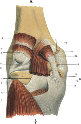 Figure 5. Depiction of same postgenual bursae. 11: medial subtendinous bursa of gastrocnemius; 13: semimembranoso-gastrocnemial bursa; 18: semimembranous bursa, prolongating in front of and behind the anterior part of semimembranosus.