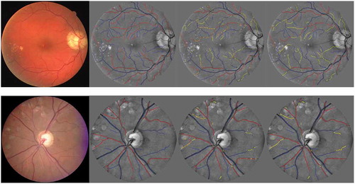 Figure 12. A/V classification results from the DRIVE and INSPIRE data sets. From left to right: the original images, the A/V label of the vessel centrelines, the pixel-wise classification and the segment-wise classification. Correctly classified arteries are in red, correctly classified veins are in blue and the wrongly classified vessels are in yellow.