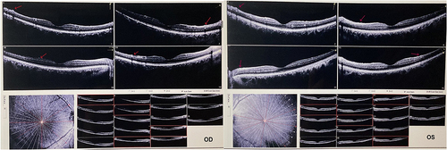 Figure 2 Optical coherence tomography examination on day 1. OS, left eye; OD, right eye. In images in each eye, pictures in the lower left corner are tomography examinations at different angles, with the results in the right lower corner. The upper four pictures are enlarged representative angles. The red arrows show the rough areas.