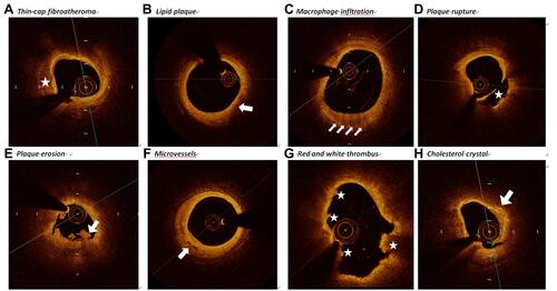 Figure 1 Representative cross-sectional optical coherence tomography images. (A) The identification of calcification was the presence of a well-delineated, low-back scattering region (asterisk). (B) Lipid plaque appears as signal-poor and diffusely bordered regions where overlying signal-rich bands (arrow). (C) Macrophages infiltration was defined as a distinct or confluent punctuate, signal-rich region of higher intensity than background speckle noise which creates conspicuous backward shadowing (arrows). (D) Plaque rupture (asterisk) was identified by uncompleted fibrous cap and cavity formation. (E) Plaque erosion identified by thrombus with an intact underlying plaque (arrows). (F) Microvessels was identified by the tubule luminal which without connection to the vessel lumen (arrow). (G) Red thrombus consists by red blood cells; relevant OCT images are characterized as high-back scattering protrusions with signal free shadowing (asterisk). White thrombi consisted by white blood cells and platelets. White thrombi were featured as low-back scattering, signal-rich and billowing projections protruding into the lumen (asterisk). (H) Cholesterol crystal (arrow) identified by backs cattering structures without prominent backward shadowing.