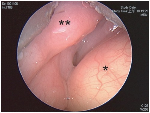 Figure 3 Laryngoscopic view. Epiglottic cyst*, lingual tonsil area**.