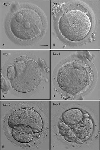 Figure 1. Clinical characteristics of oocytes retrieved from the infertile patient. The day of oocyte retrieval was defined as day 0. Scale bar = 20 µm. (A) The morphology of a normal mature PB2 oocyte. (B) The morphology of a normal fertilized oocyte with two pronuclei (2PN). (C) The morphology of an abnormal mature oocyte with multiple large-polar bodies. (D) The morphology of an abnormal fertilized oocyte with one pronuclei (1PN). (E) The morphology of an abnormal mature oocyte with a large-polar body. (F) The morphology of an oocyte that has undergone cleavage 18 h after fertilization