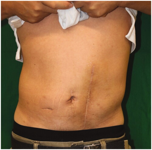 Figure 3. Postoperative appearance 6 months after last surgery. There was no sign of recurrence of the hernia and bulge.