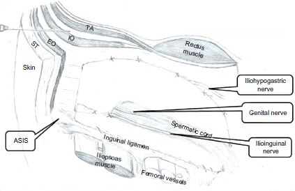 Figure 2 Insertion of a blunt needle penetrating the fascia of the external and internal oblique muscles before entering the transversus abdominis fascial plane.