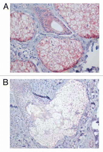 Figure 4 Localisation of COX-2 immunostaining in the sebaceous gland of acne patients (A) and in the normal skin of healthy controls (B). Very strong immunoreaction of the gene within the sebaceous gland of acne skin, especially, in undifferentiated and early differentiated sebocytes is seen (A) (x400). Weak immunoexpression of COX-2 in the sebaceous gland and ductal cells of healthy skin (B) (x400).