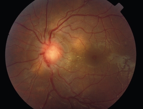 Figure 2 Fundus photograph OS shows the optic nerve granuloma caused by direct sarcoid tissue infiltration.