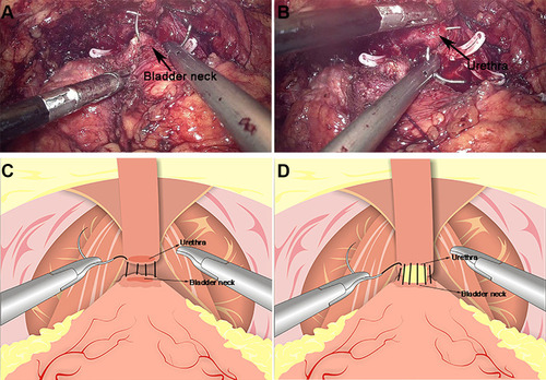 Figure 3 Anastomosis of bladder and urethra of total urethral reconstruction of the “Sandwich”. (A) The structural location of the bladder neck during the operation. (B) The structural location of the urethra. (C) A running urethrovesical anastomosis was performed with the posterior wall suturing from 4 o’clock to 8 o’clock. (D) A urethrovesical anastomosis was performed with the front wall suturing from 3 o’clock to 9 o’clock.