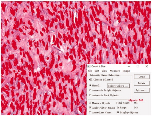 Figure 3. SMC count. Histopathological images with hematoxylin and eosin staining of uterine fibroids, microscopic magnification, ×400. Image-Proplus analysis software automatically identified the nucleus (the nucleus of SMC is shown in dark red) and the cellular count was 243 in the field.