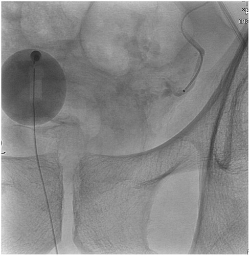 Figure 3. Angiography after Prostate Artery Embolization (PAE) treatment, showing occlusion of the inferior vesical artery.