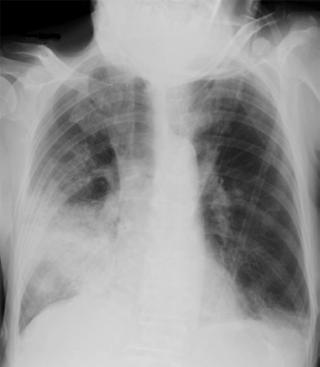 Figure 1 Chest radiograph on day of admission.