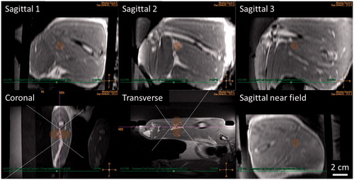 Figure 3. Mild hyperthermia treatment planning in a rabbit Vx2 thigh tumour using a clinical MR-HIFU system. Three-dimensional reconstruction of contrast-enhanced T1-weighted images acquired for mild hyperthermia treatment planning. Ultrasound beam and treatment cell overlays used to guide translation and rotation of transducer to avoid heating skin, bone, and sensitive structures. For figure clarity, semi-transparent ultrasound beam overlays shown by the treatment planning software are replaced here with dotted outlines. Treatment cell overlays are shaded.