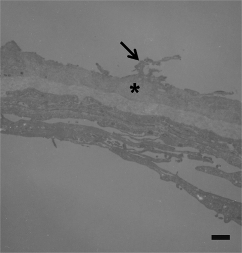 Figure 1 Transmission electron micrographs of internal limiting membranes removed from eyes with idiopathic macular epiretinal membrane. Specimen shows fragments of retinal debris (arrow) at the retinal side of the internal limiting membrane (asterisk) (original magnification × 4400; bar = 1.7 μm).
