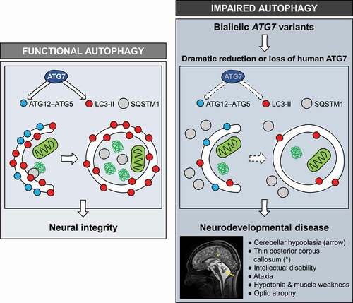 Figure 1. Functional autophagy in humans ensures neural integrity (left panel). Patients with bi-allelic ATG7 variants demonstrate loss or diminished levels of ATG7 protein, impairing autophagy (hallmarked by attenuated LC3 lipidation and SQSTM1 accumulation) and leading to complex neurodevelopmental disease (right panel)