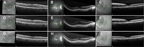 Figure 1 Macular SD-OCT of 3 patients with macular edema secondary to radiation retinopathy (A), epiretinal membrane with myopic degeneration (B), and diabetic retinopathy (C). OCT B-scans before bevacizumab injection (ABC) and 6 weeks after bevacizumab injections (D–F) show no significant improvement. However, OCT comparison scans 6 weeks after brolucizumab injections show a marked improvement in macular anatomy (G–I).