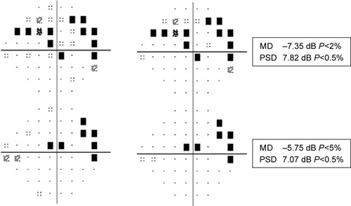 Figure 2 Changes in visual field parameters (improvement in the mean deviation and stability of pattern standard deviation) in one of the patients from the initial visit before starting rituximab (upper panel) to the last visit (lower panel).