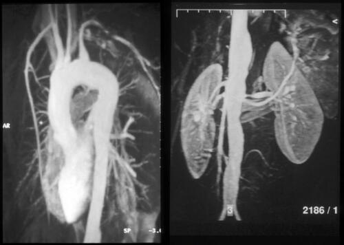 Figure 2 Conventional angiography in a 24-year-old woman with Takayasu disease (TAK) showing stenosis of the left subclavian artery, moderate dilatation of the entire thoracic aorta, irregular dilatation of the abdominal aorta, and stenosis of the left renal artery.