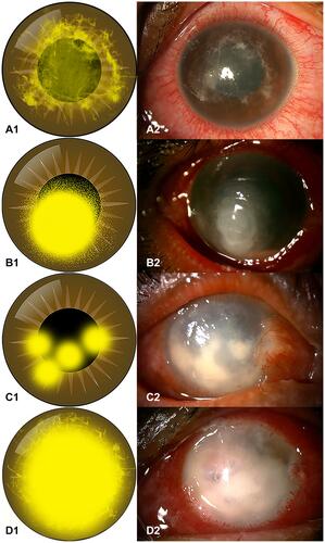 Figure 1 Diagrams of infiltration pattern and clinical slit-lamp photographs. (A1 and A2) Diagram of a reticular infiltration pattern and a photograph of a 21-year-old student who had a history of contact-lens wearing and presented at KCMH two days after left eye irritation (Case#21); (B1 and B2) diagram of a satellite infiltration pattern and a photograph of a 55-year-old farmer who had a trauma to the right eye from grass leaves (Case#15); (C1 and C2) diagram of a multifocal infiltration pattern and a photograph of a 58-year-old farmer who had a trauma of the right eye with soil contamination (Case#24); (D1 and D2) diagram of a total infiltration pattern and a photograph of the right eye of a 61-year-old female without a significant history of ocular trauma (Case#10).