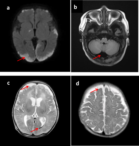 Figure 1 Head magnetic resonance imaging of late-onset GBS meningitis in the twins and the compatriots after admission. (a): Increased subdural effusion and meningoencephalitis were revealed in compatriot A. (b): Formation of occipital arachnoid cyst was found in compatriot B. (c): Bilateral frontal subdural empyema and hemorrhage was indicated in twin A. (d): Suppurative meningitis was diagnosed in twin B. The red arrow points to the focal area.