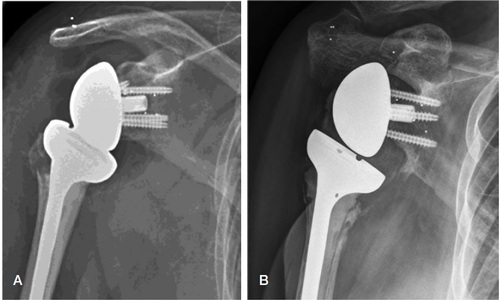 Figure 1. Radiograph of a patient operated with a reverse total shoulder arthroplasty postoperatively (A) and at 2-year follow-up (B), where “notching” grade 3 can be observed in the inferior scapular neck. RSA markers were implanted in the scapular neck, coracoid, and acromion.